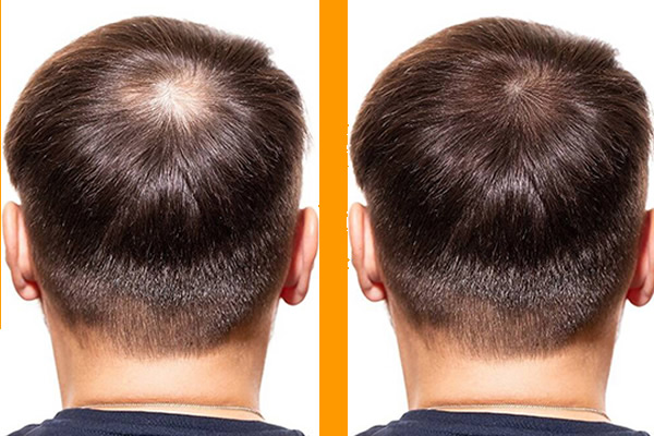 before & after photos showing hair growth after PRP stem cell therapy