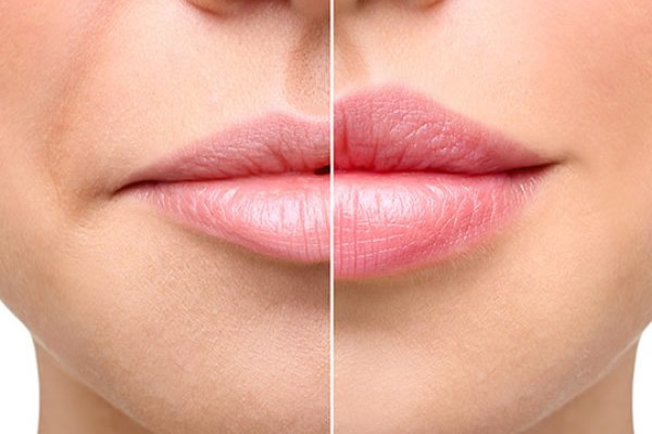 before after photo showing dermal lip filler therapy