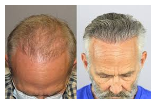 hair-restoration-before-after-1