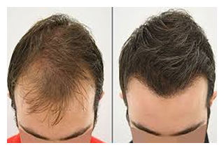 hair-restoration-before-after-2