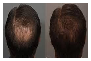 hair-restoration-before-after-3