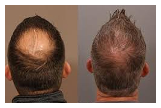 hair-restoration-before-after-4