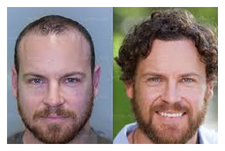 hair-restoration-before-after-5