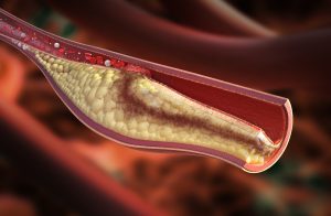 Carotid Intima-Media Thickness