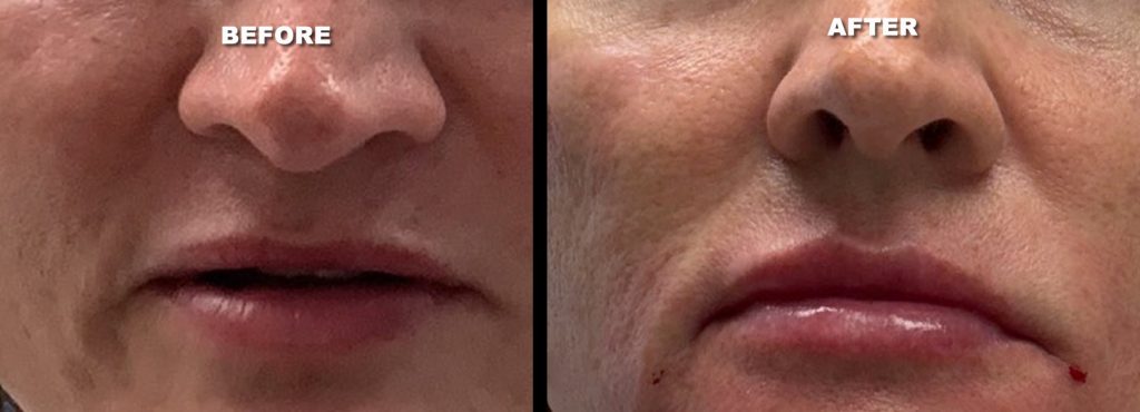 Dermal Filler Lip Injection - Patient Before and After photo