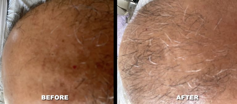 Hair restoration male patient - before & after photo