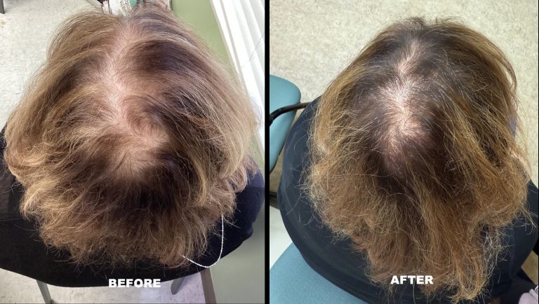 Hair restoration female patient - before & after photo